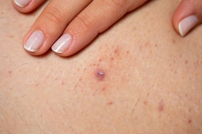 Szőrtüszőgyulladás, szőrbenövés oka, tünetei és kezelése