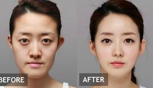 A South Korean lady before and after surgery [Koreaboo]