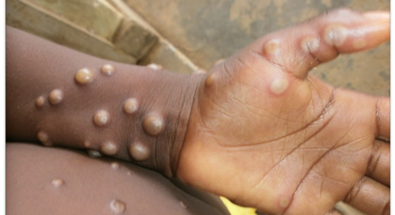 Monkey pox is a rare disease caused by monkeypox virus [WHO]