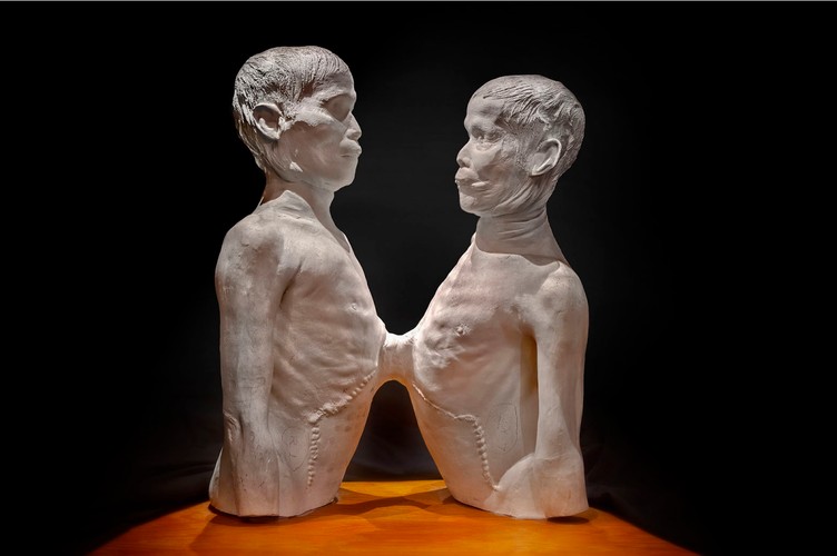 Chang Bunker i Eng Bunker to bliźniacy z Tajlandii, od których pochodzi termin bliźnięta syjamskie.