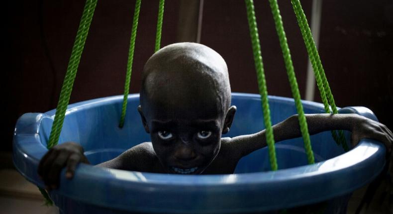 A malnourished girl being weighed, a daily for children who are hospitalised for a little over a week until their weight recovers