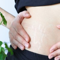 Csíkok a bőrön: striának tűnhet, pedig hormonális oka is lehet!