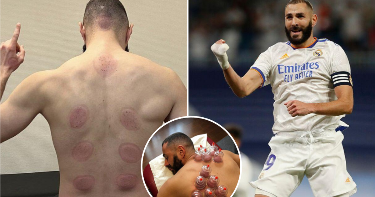 What is 'hijama' and why is Karim Benzema a fan of it? | Pulse Nigeria