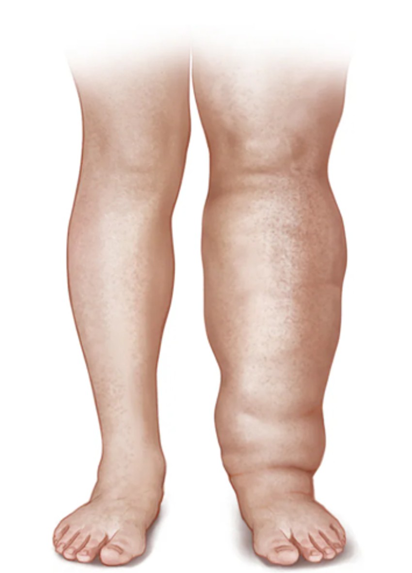 Limfedem je otok u ruci ili nozi. U retkim okolnostima, pogađa obe ruke ili obe noge. Takođe može uticati na grudni koš i abdomen