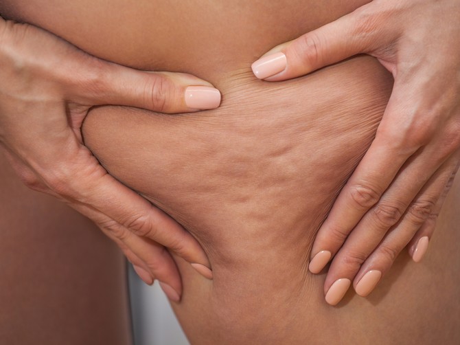 Stručnjaci upozoravaju da je važno razlikovati celulit od lipedema