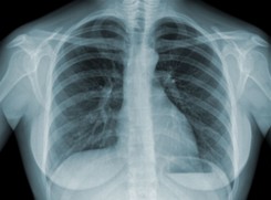 Sztuczna inteligencja może identyfikować COVID-19 w płucach. Na podstawie RTG