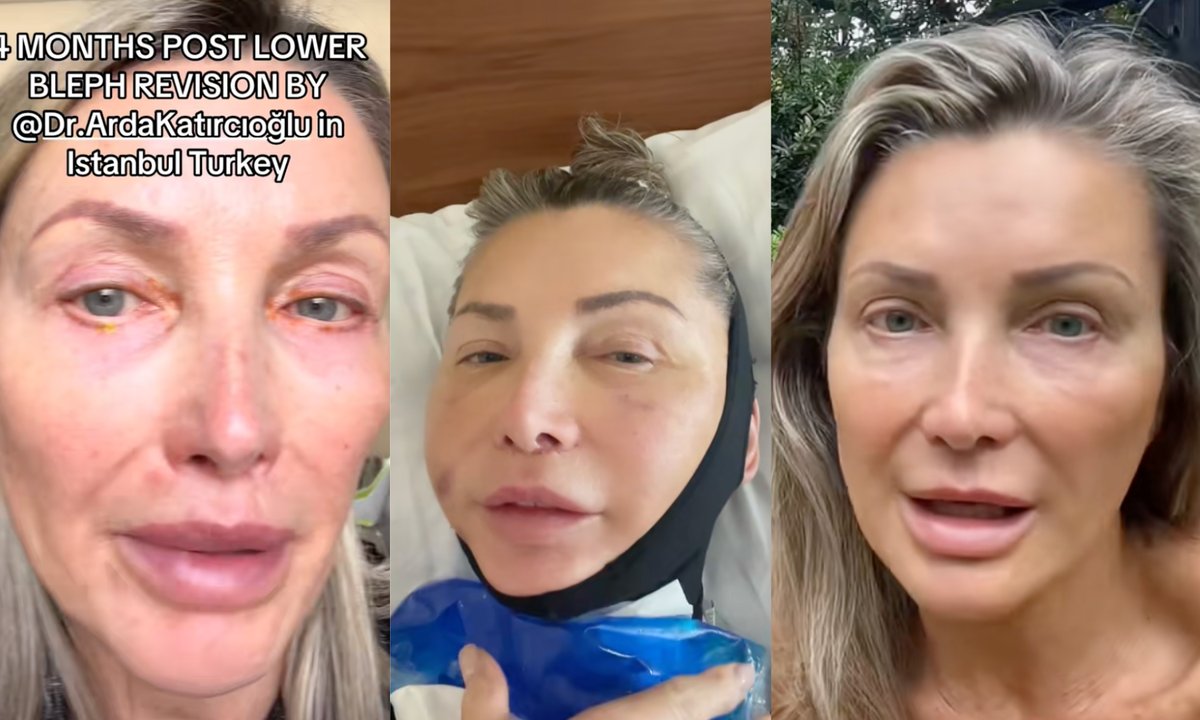 Tiktokerka zrobiła sobie lifting. Pokazała efekty. "20 lat młodziej"