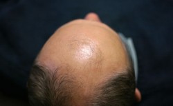 Przeszczepy tysięcy własnych włosów w dwa dni, zamiast w dwa lata