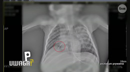 Szpital wypisał półtoraroczną dziewczynkę z igłą w płucach