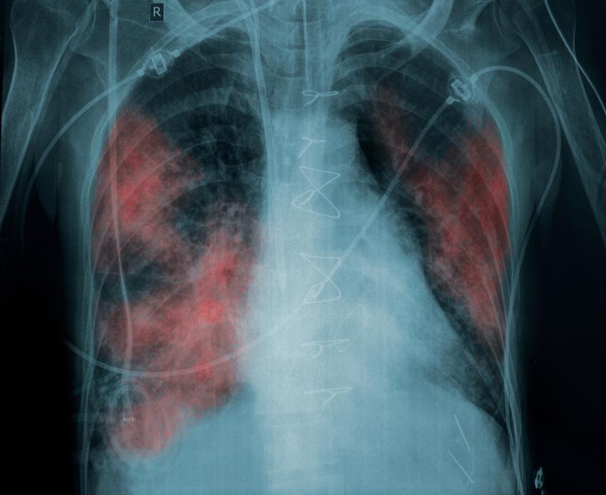 tuberkulózis és dohányzás elleni védekezés