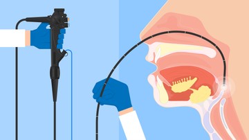 A kivizsgálás során számíthat laryngoscopos vizsgálatra a fül-orr-gégészeten, ilyenkor vékony endoszkóppal vizsgálják a gége, a hangszalagok mozgásait és állapotát. 