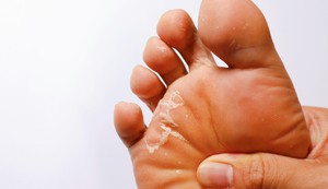 Ljuštenje i perutanje kože na stopalima može biti posledica suve kože, gljivičnih infekcija, dermatoloških oboljenja ili iritacije i opekotina