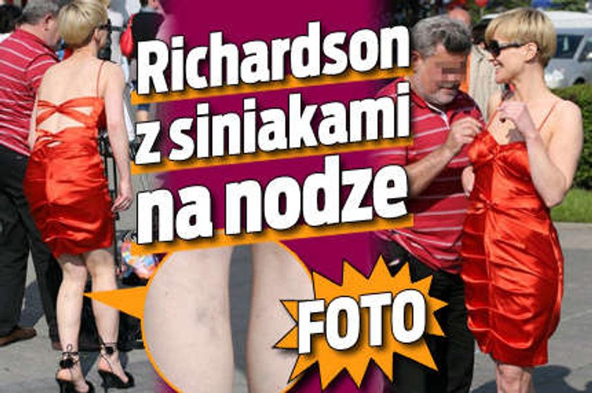 Richardson z siniakami na nodze. Foto