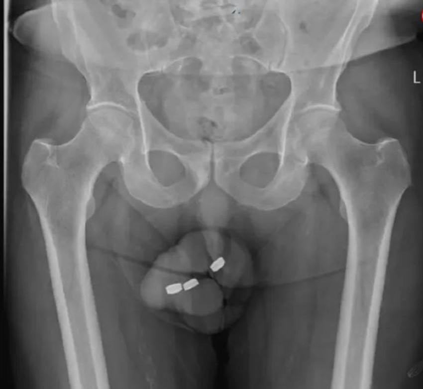 Baterije u polnom organu