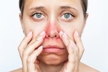 piros orr, hajszálér, rosacea