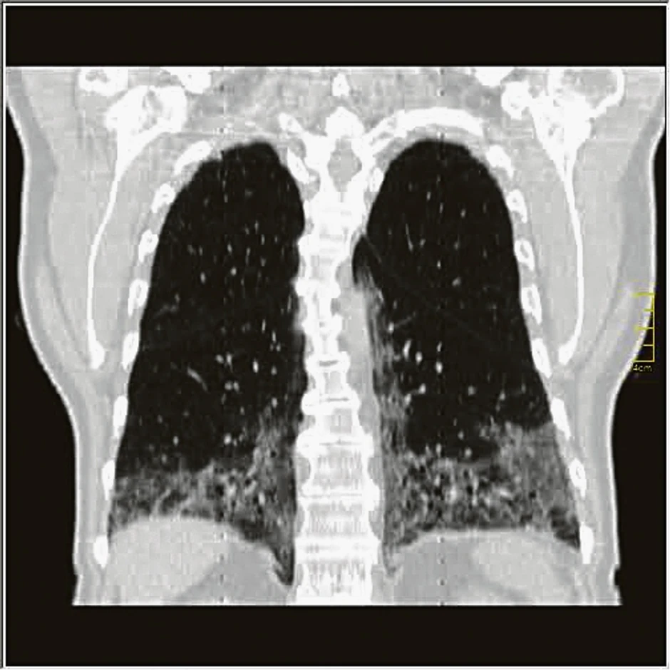 Progresivna faza (5. do 8. dan) - povećanje broja GGO i crazy paving