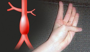 Az aorta aneurizma illusztrációja és a hüvelykujj-tenyér teszt bemutatása.