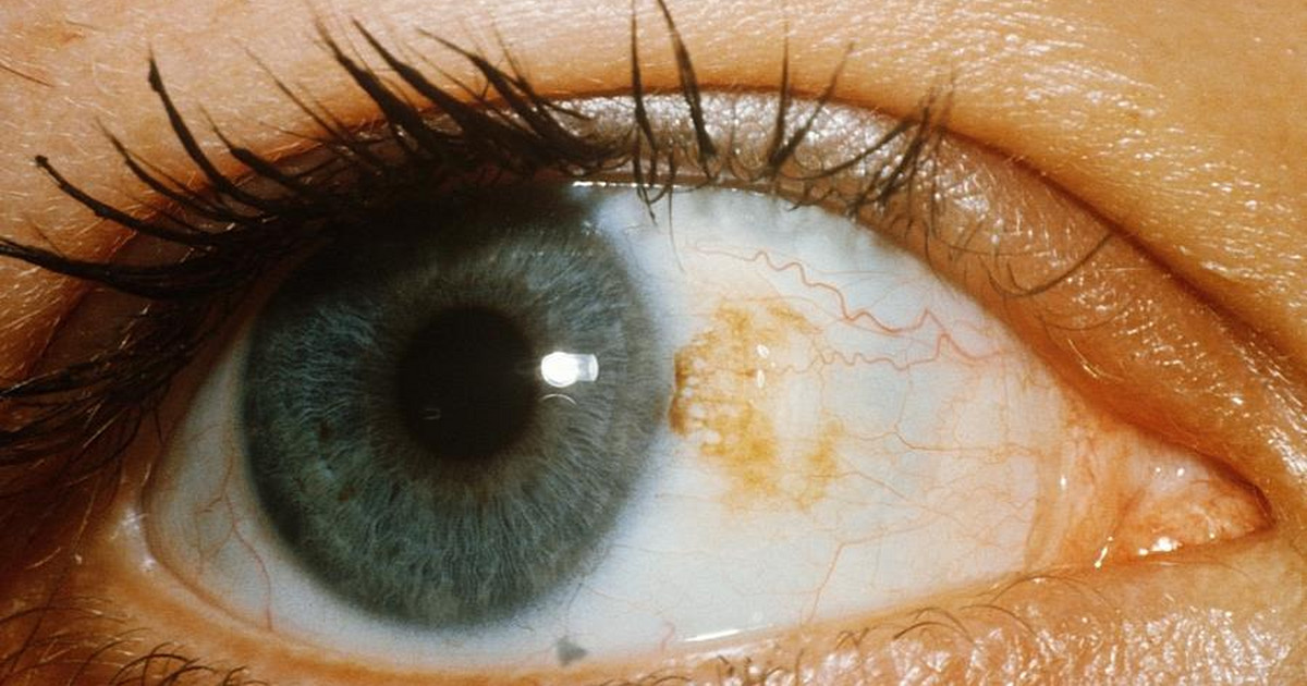 Witrektomia - wskazania do zabiegu. Jak wygląda operacja siatkówki oka?