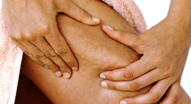 How to get rid of cellulite naturally [WebMD]