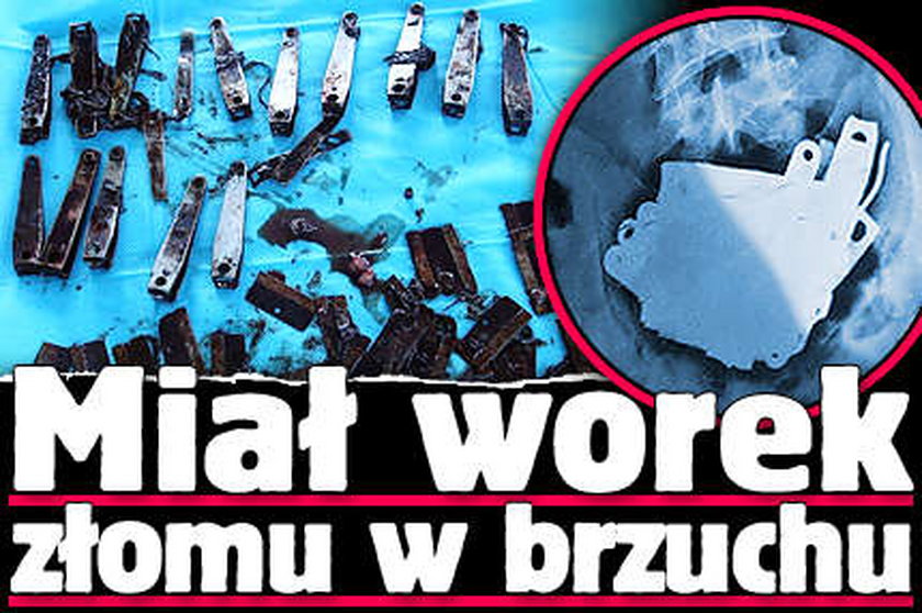 Z brzucha Chińczyka wyciągnęli worek złomu