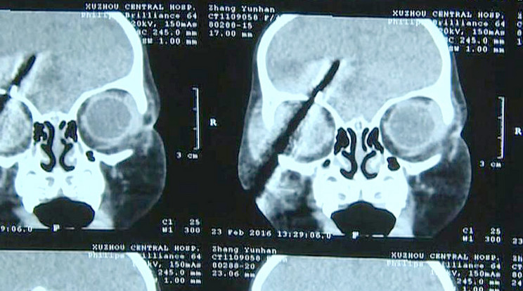 Röntgenfelvétel a koponyába fúródott csavarhúzóról/ Fotó: PuzzlePix