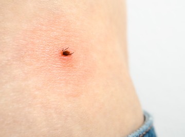 Endometriózis és Lyme-kór: így függ össze a kettő betegség