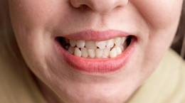 Jak wyprostować krzywe zęby bez aparatu? Dentystka tłumaczy
