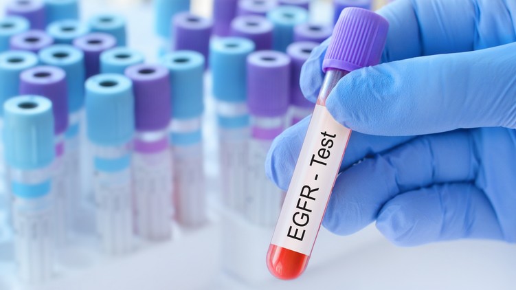Mit jelent eGFR érték laborlelet