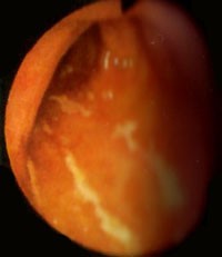 endoscopy2-d00000EB4b29f4699e90b