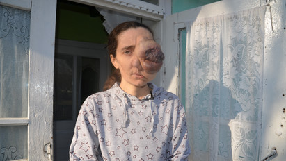 Brutális: Óriási tumor nőtt ki az anyuka szeméből - fotók 18+