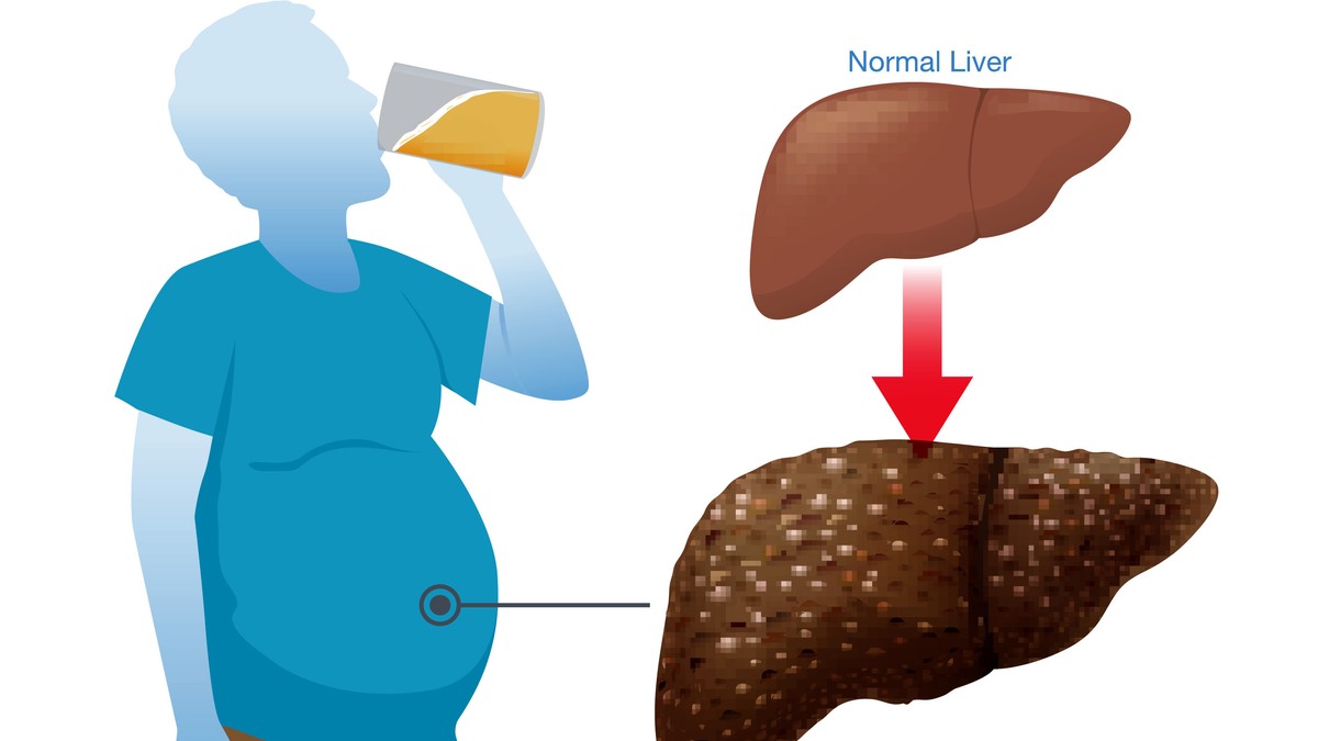Vikend opijanje je štetnije za jetru nego isti broj pića raspoređen tokom nedelje