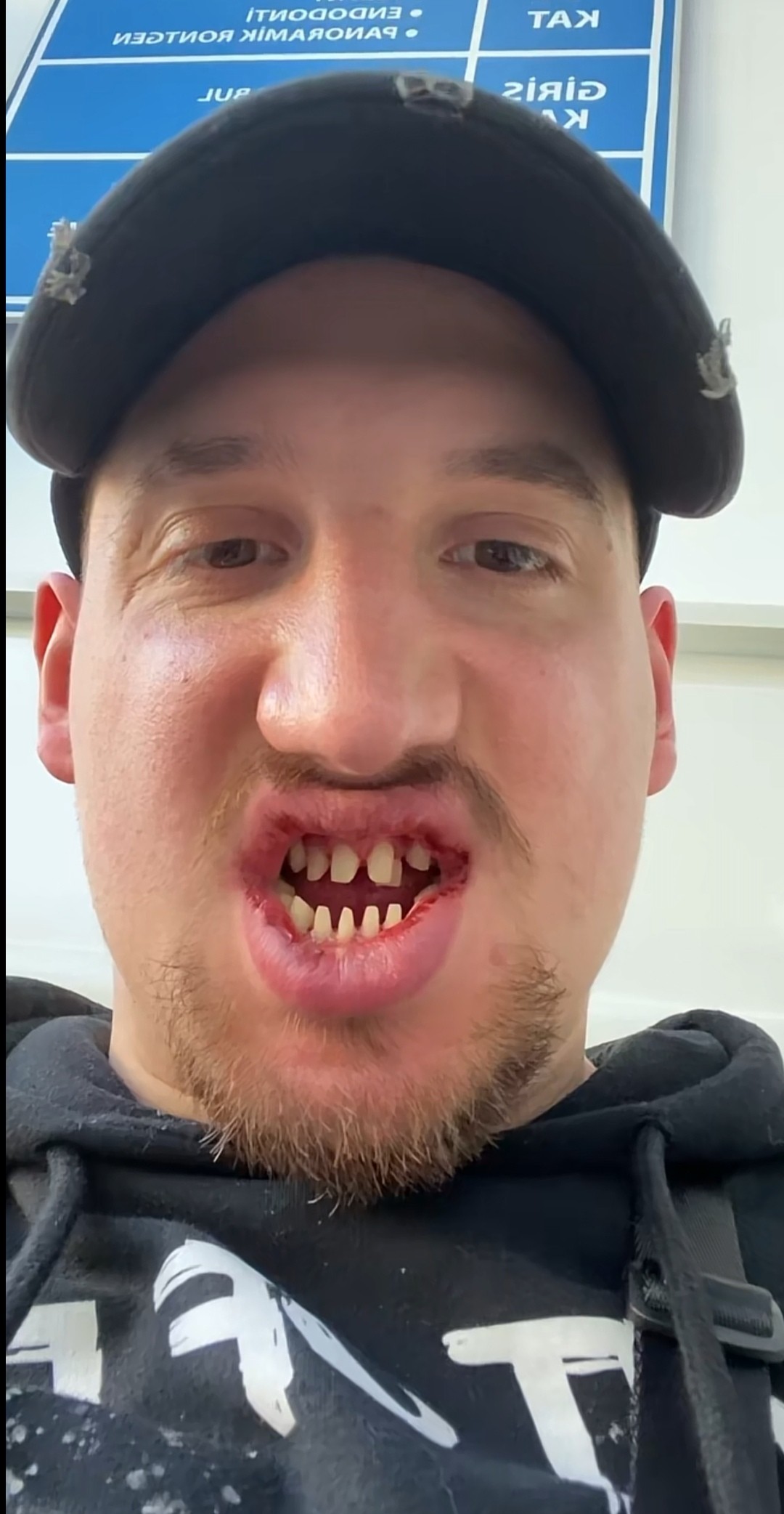 Dustin sa na TikToku pochválil svojím novým chrupom. 