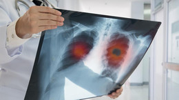 Objawy raka płuc