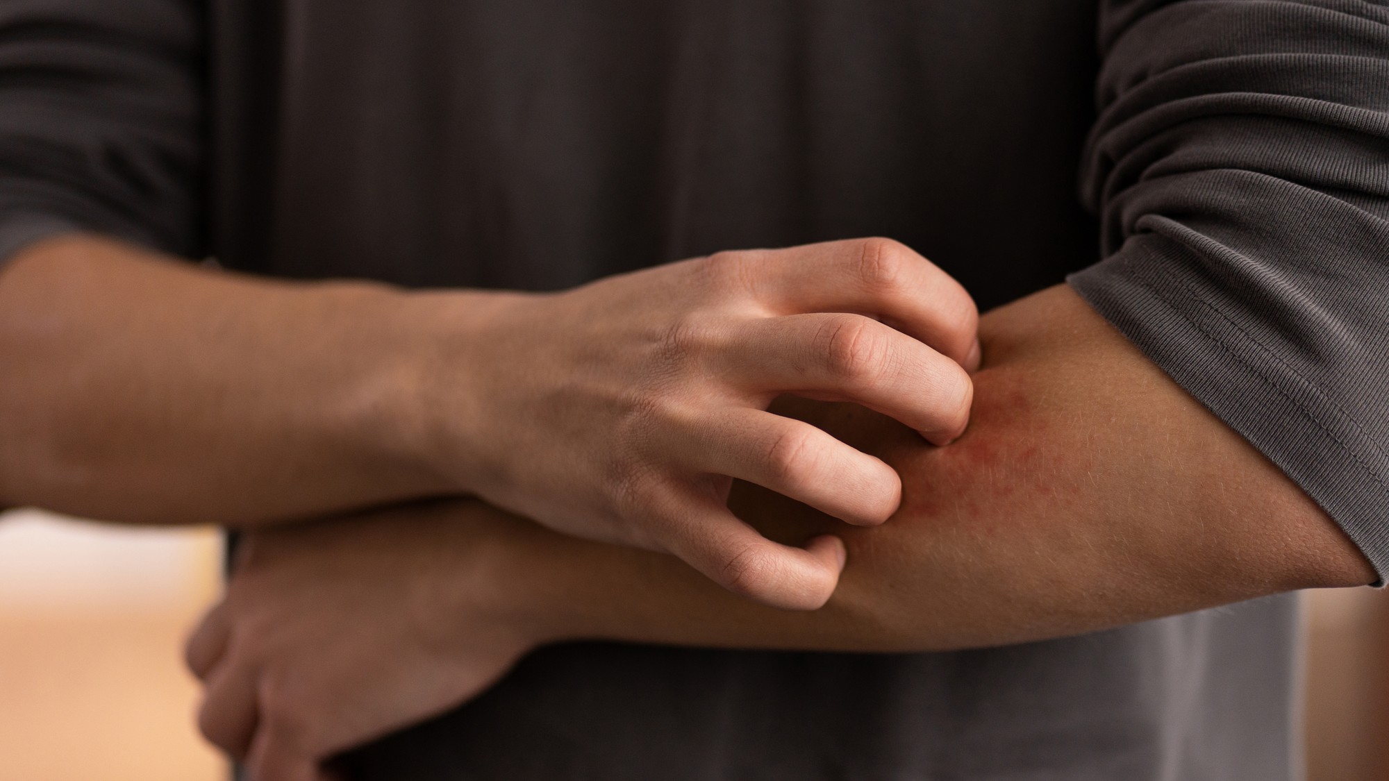 Nevinné poškrabanie či vyšklbnutie môže pre organizmus znamenať riziko vzniku infekcií.