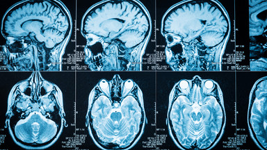 Dziedziczna choroba genetyczna, która powoduje zaburzenia zdolności poruszania się, myślenia i sprawności psychicznej