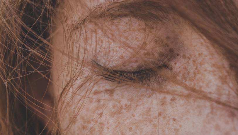 Pigmentflecken entfernen – Die beste Creme für Gesicht & Körper