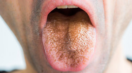 &quot;Czarny włochaty język&quot; - choroba, którą może wywołać zażywanie dużych ilości antybiotyków. Czym grozi?