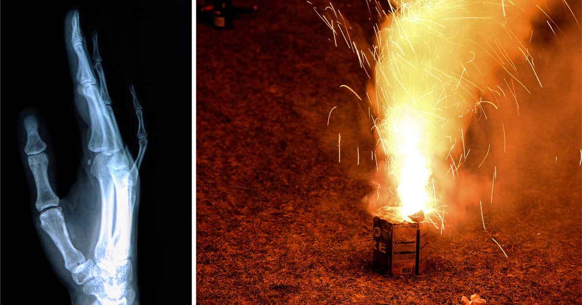 Koszmar. Petarda wybuchła w dłoni dziecka. Konieczna była amputacja