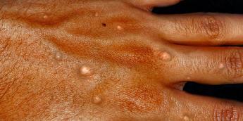 Monkeypox on a hand-Healthdirect