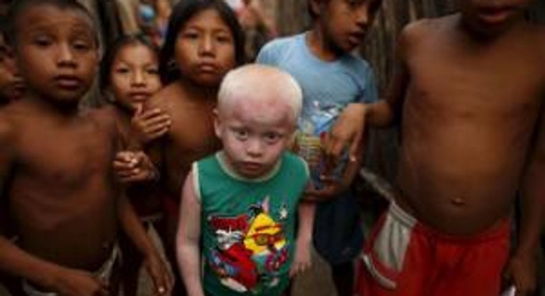 Albinos battle a bright foe