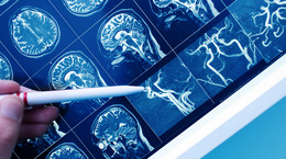 Co się dzieje z mózgiem w chorobie Alzheimera? Samobójcza śmierć komórek