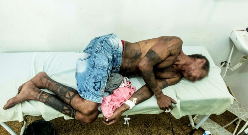 An indigenous Gamela man receives medical attention at a hospital in Viana, Brazil, on April 30, 2017, after being attacked by farmers