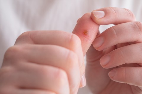 Szemölcs: tünetek, vizsgálatok és kezelési lehetőségek