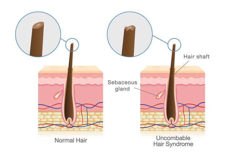 Łodyga włosa (po lewej) i łodyga włosa z syndromem nieuczesanych włosów (po prawej)