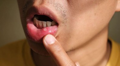 Mouth ulcers: 4 home remedies to treat sore in the mouth