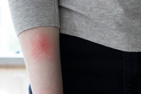 Évekkel később is gondot okozhat a kullancscsípés – ezek a Lyme-kór késői tünetei