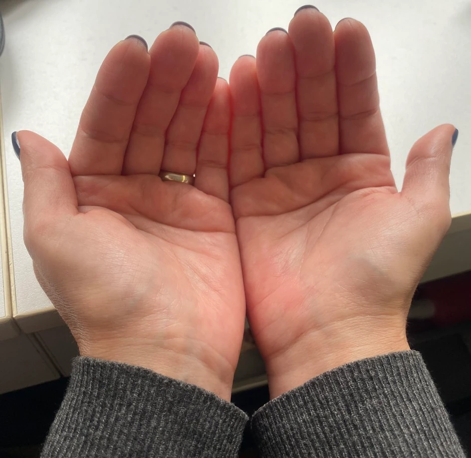 Palmarna eritema ponekad nema poznati uzrok