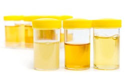 Urynoterapia rzeczywiście działa? Właściwości moczu