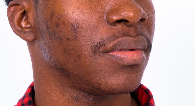 Adult acne