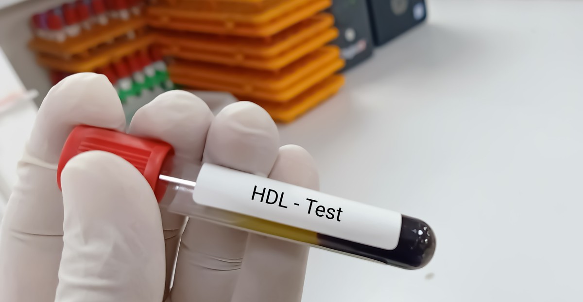 Co oznacza cholesterol HDL za niski? Ekspertka wyjaśnia